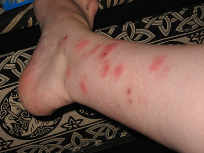 Black Widow Spider Bites. black widow spider bite pictures. Black Widow Spider Bites.